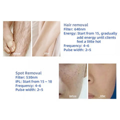 3 In 1 Yag Laser E Light Ipl Opt Hair Removal e-light Ipl Rf Nd Yag Laser Tattoo Removal Multifunction hair removal Machine