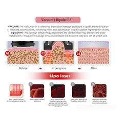 Portable 6 in 1 Skin Tightening Face Lifting Weight Loss Fat Burner RF Lipocavitation Body Sculpt 40K Weight Loss Cavit Machine