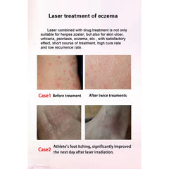 Portable New High Power Physical Therapy 980 1064 nm Pain Relief Laser Therapy Physiotherapy Machine