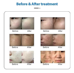 Korea DPL laser hair removal Photorejuvenation Whitening and lightening hair removal beauty machine