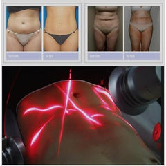 Hot sales 532nm 635nm Fat Removal Device 6D Lipolaser Laser Lipolysis Machine Laser Shape 6D Laser Slimming Machine