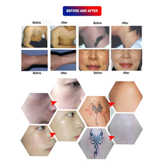 Pico Laser Machine Co2 Fractional laser Machine Skin Resurfacing Pigment Spots Removal Laser machine