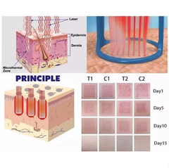 Portable laser co2 fractional Removal Stretch Mark Private and Tight Skin Repair Beauty Machine