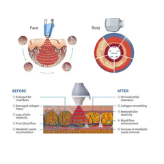 360 Ultrasonic Fat Knife Emtone Facelift Fat Reduction Wrinkle Removal Ultrasonic Facial Lifting and Firming Machine