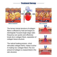 Hot sale exili rf Focused RF Ultrasound Machine For Body Slimming exilis RF Wrinkle Removal Face Lifting machine