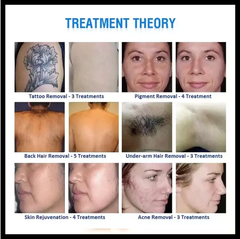 2 in 1 diode laser hair removal pico diode machine permanent hair removal underarm whitening laser