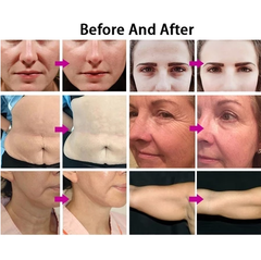 DDMay MFU+RF slimming machine for body and face 7D hifu facial machine anti aging face lifting device