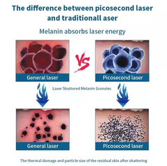 portable diode laser hair removal machine 2 in 1 laser picosecond tattoo removal ipl hair removal 755nm