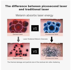 pico laser machine permanent tattoo removal Nd Yag carbon laser machine Picosecond Laser whitening