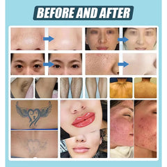 4 in 1 Opt + Ipl+ Rf+ Nd Yag Permanent Laser Tattoo Removal Skin Rejuvenation Beauty Equipment Electrolysis Hair Removal Machine