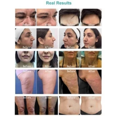 New Electrica Microneedle RF Depth 8 Double handles Face Lifting Machine Beauty Instrument