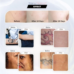 Pico laser carbon machine super picosecond 755nm and scar freckle Mole removal beauty machine