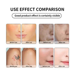 Pico Laser 750Ps Picosecond Q Switched Nd Yag Laser 1064Nm 532Nm 755Nm Tattoo Removal Picosecond Laser Machine