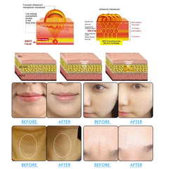 Portable 8D Hifu 9D 10D Machine Body Shape Cartridge 1 Handle Hifu Facial 12D Antiwrinkle Machine Hifu Machine 9D
