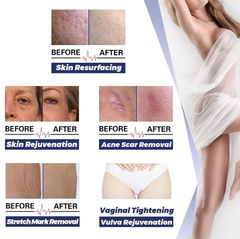 Portable laser co2 fractional Removal Stretch Mark Private and Tight Skin Repair Beauty Machine