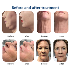 7D hifu facial machine slimmer face anti aging face lifting device face lifter skin firming v shape