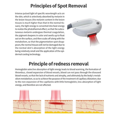 Korea DPL laser hair removal Photorejuvenation Whitening and lightening hair removal beauty machine