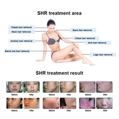 ipl laser hair removal diode laser hair removal underarm laser whitening permanent hair removal Freezing Point Hair Removal Device