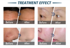 14 In 1 Hydro Oxygen Jet Skin Rejuvenation Machine Professional Hydradermabrasion Beauty Machine