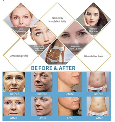 5 In 1 HIFU Beauty Machine 9D MAX