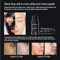 pico laser machine permanent tattoo removal Nd Yag carbon laser machine Picosecond Laser whitening