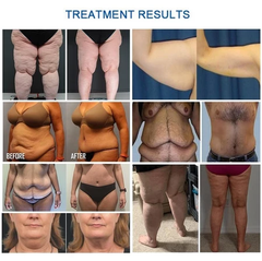 360 Cryolipolyse Cellulite Reduction Cool-Body Sculpting Slimming Fat Freeze Cryolipolysis Machine