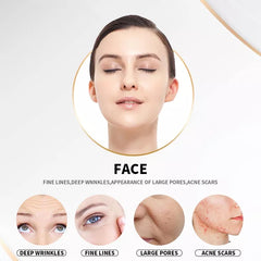 2 In 1 Skin Lifting Gold RF Ice Hammer Fractional rf Microneedling Face rf Microneedling With Cold Hsmmer /Gold Micro Needle Skin Rollar Acne Scar Stretch Mark Removal Treatment Be