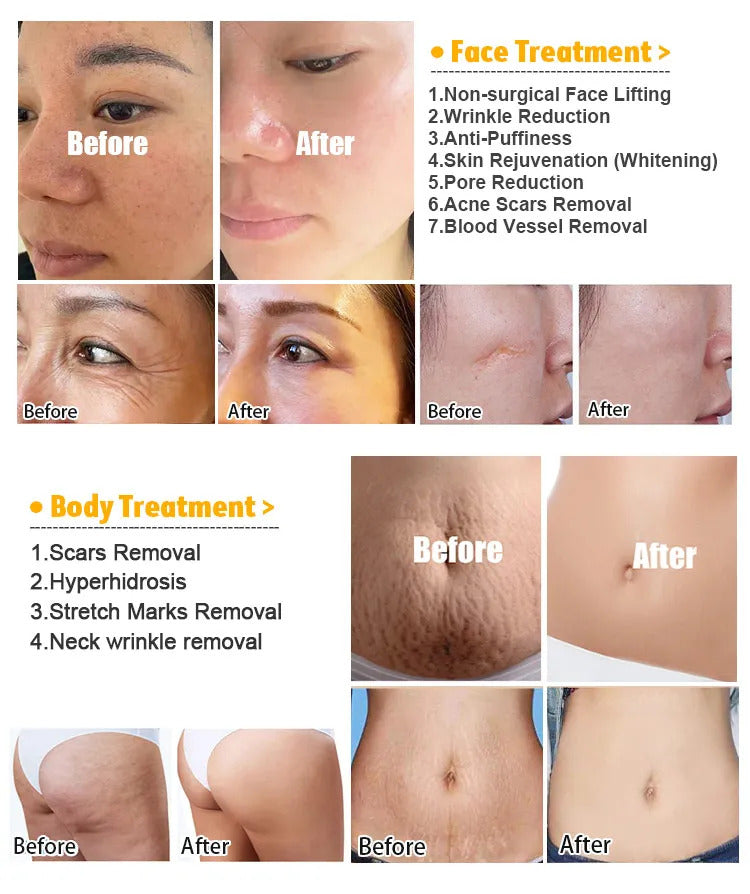 fractional gold rf beauty machine like morephus 8 style acne removal + 4 tip