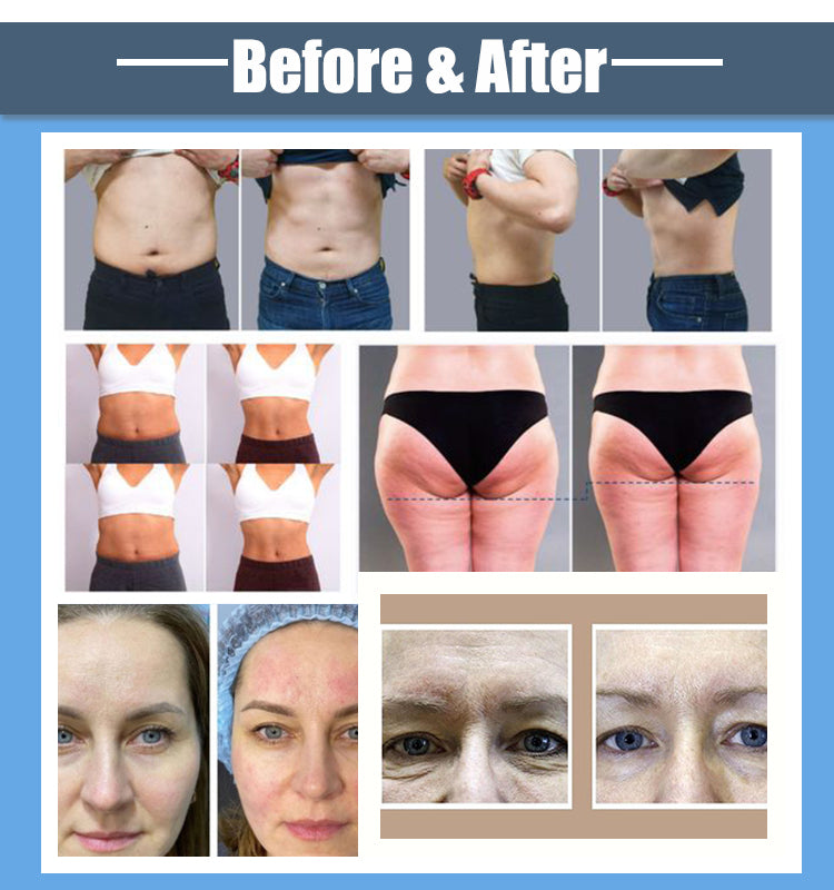 2025 New Monopolar RF Face Skin Rejuvenation & Ultra 2-in-1 360 Body Contouring Machine: Cellulite Reduction & Tightening, Versi