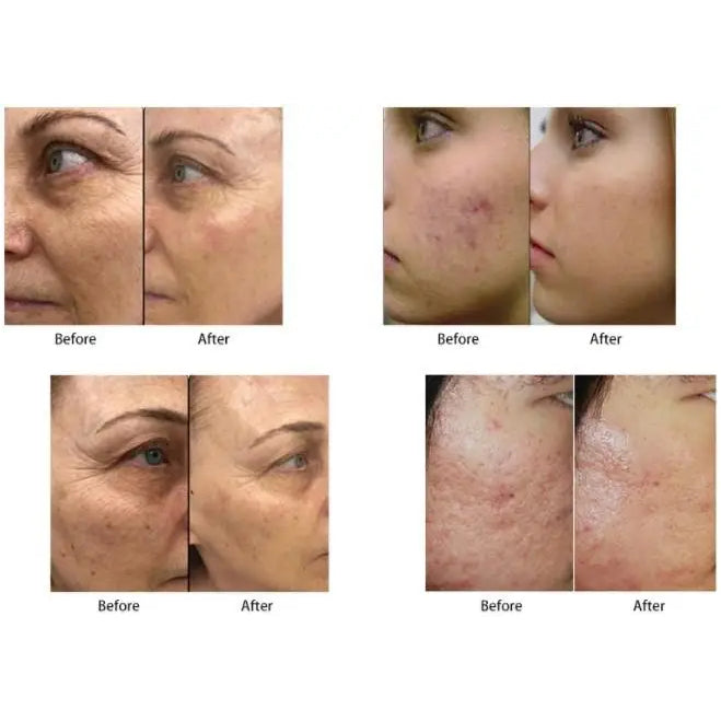 Gold fractional morpheus 8 facial y body y rf microneedling catridges 40 pins inmode radiofrecuent morpheus8 machine