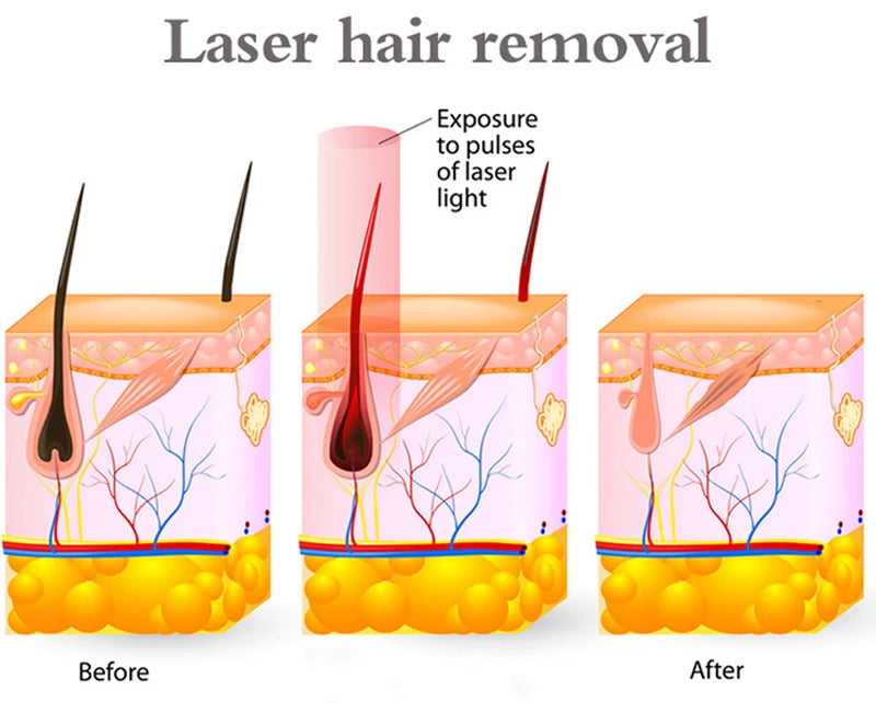 2 handles diode pico laser machine permanent hair removal tattoo freckle removal
