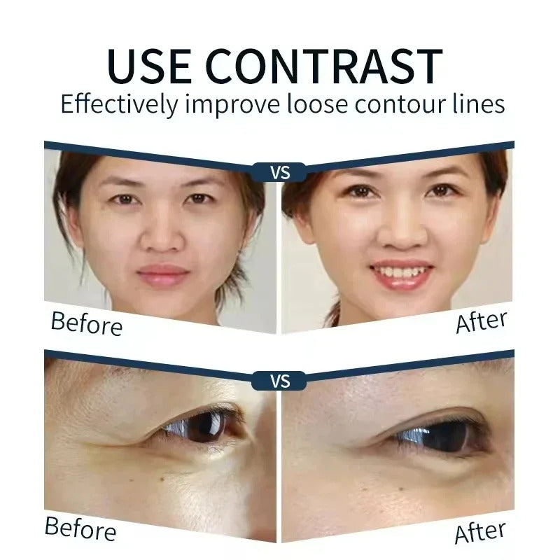 Facial Layering Skin Lift Care rejuvenation RF Precise Anti-Aging Facial Heat Lifting Tightening Eye Bag Wrinkle Removal Machine
