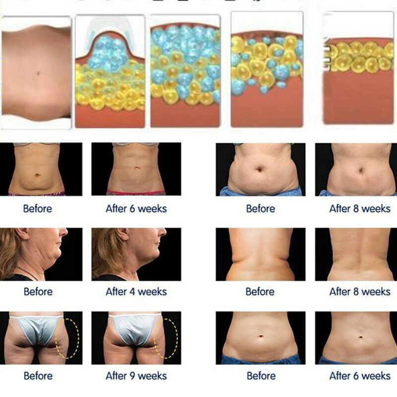 Cryo Electroporation Beauty Machine For Tightening At Removal Slimming Machine Vacuum Weight Loss Machine At Removal Slimming