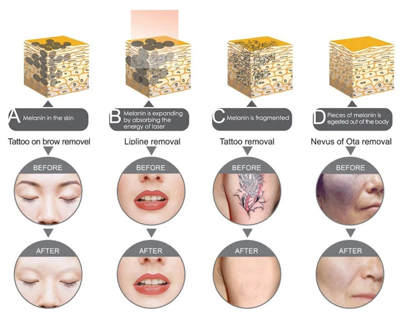 Laser Tattoo Removal  Picosecond Equipment  New Upgraded Freckle Machine Q-switched Advanced Skin Pigment Removal Machine