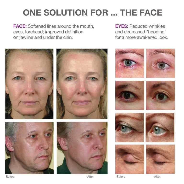 Portable 9D HIFU Facial Lifting Anti Aging Wrinkle Removal V-aginal tightening repair  Beauty Machine with rf thermage Face Sculptor Skin Tightening Anti-wrinkle Device