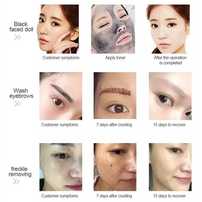 2025Portable 1064nm 532nm 1320nm ND YAG Laser Spots Tattoo Removal Eyebrow Pigment Trolley Case Picosecond Beauty Machine