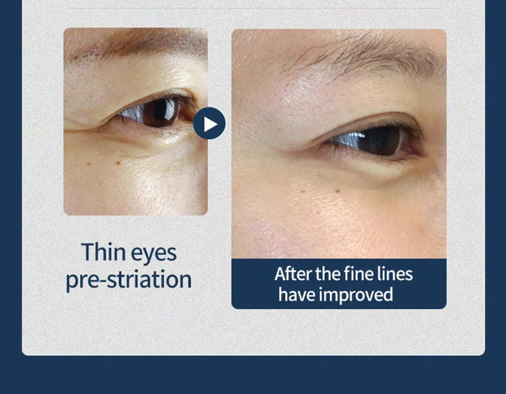 Facial Layering Skin Lift Care rejuvenation RF Precise Anti-Aging Facial Heat Lifting Tightening Eye Bag Wrinkle Removal Machine