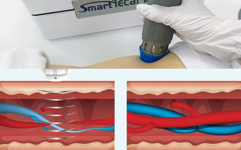 Sport Physical Shockwave Therapy Machine F Low Back Pain Tecar Massage Equipment