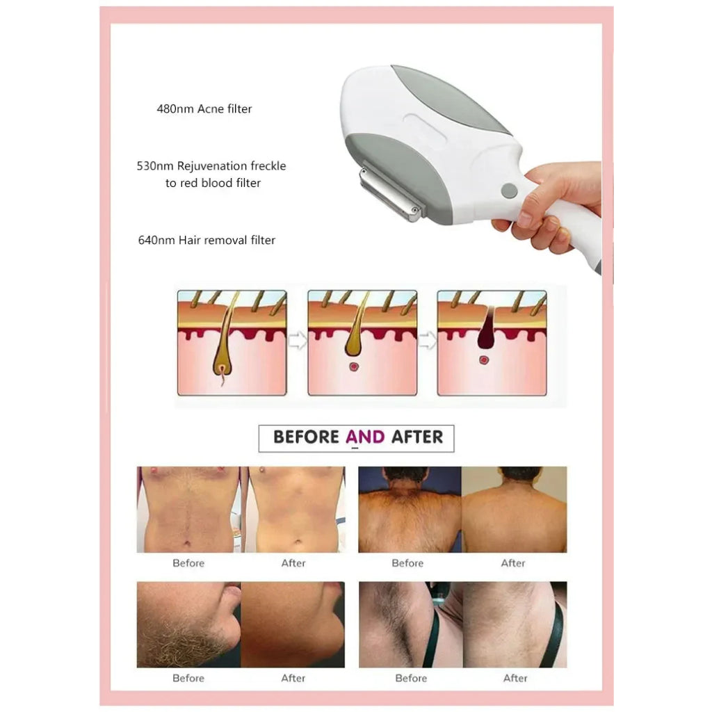 4 in 1 Opt + Ipl+ Rf+ Nd Yag Permanent Laser Tattoo Removal Skin Rejuvenation Beauty Equipment Electrolysis Hair Removal Machine