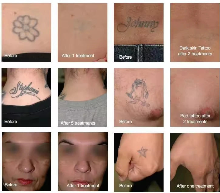 Laser Tattoo Removal  Picosecond Equipment  New Upgraded Freckle Machine Q-switched Advanced Skin Pigment Removal Machine