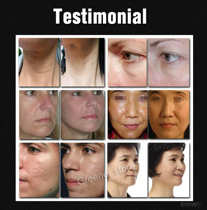 Beauty Machine Skin Tightening Eye Lifting Wrinkle Remove RF-Fractional Home Use