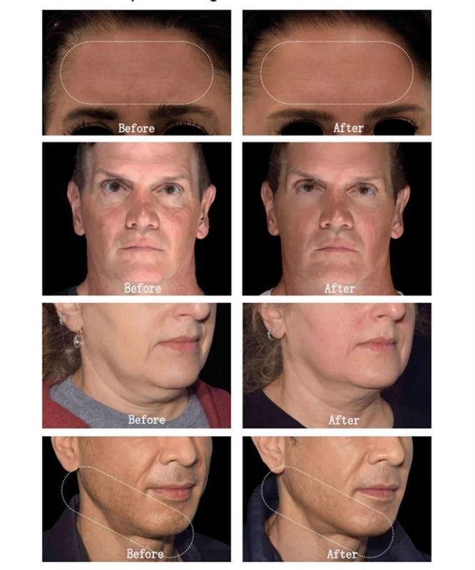 Portable EMS Anti-Aging Facial Muscle Stimulator PE Wrinkle Removal Face Lift Skin Tightening Device for Beauty Care