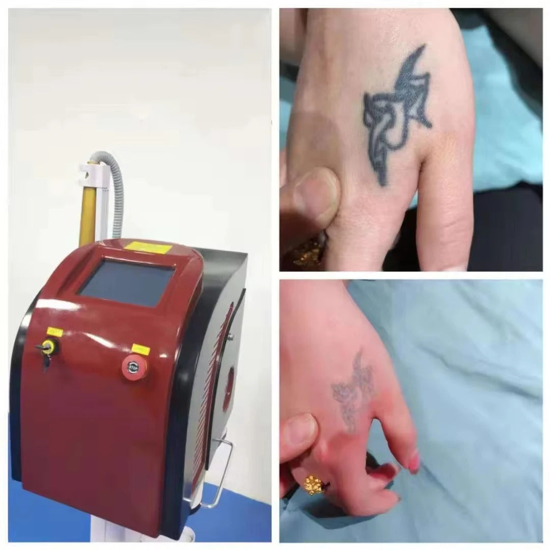 Laser Tattoo Removal  Picosecond Equipment  New Upgraded Freckle Machine Q-switched Advanced Skin Pigment Removal Machine