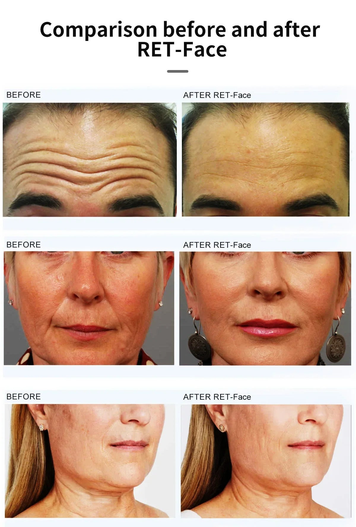 Portable RF Facial Electrical Stimulation Anti-Aging Machine - Face Wrinkles Removal Skin Tightening Lifting Device for Home Use
