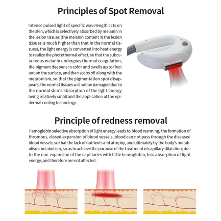 Korea DPL laser hair removal Photorejuvenation Whitening and lightening hair removal beauty machine
