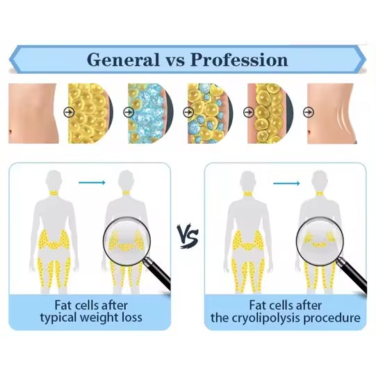 4 Handle Cryo Fat Freeze Slimming Machine 4D 360 Cryo Fat Freezing Machine Weight Loss Cellulite Reduction Cryolipolysis Machine
