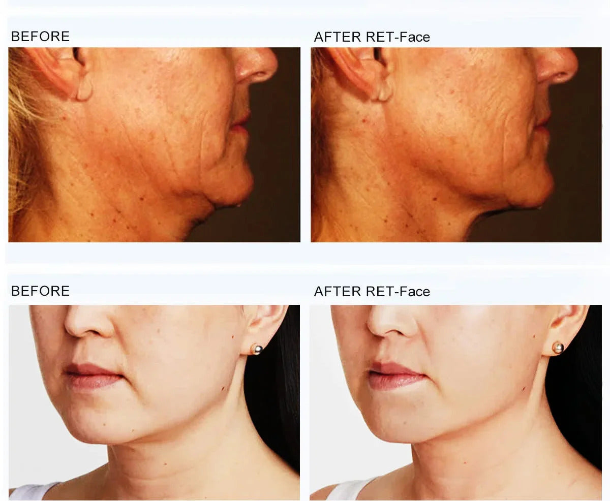 Portable RF Facial Electrical Stimulation Anti-Aging Machine - Face Wrinkles Removal Skin Tightening Lifting Device for Home Use