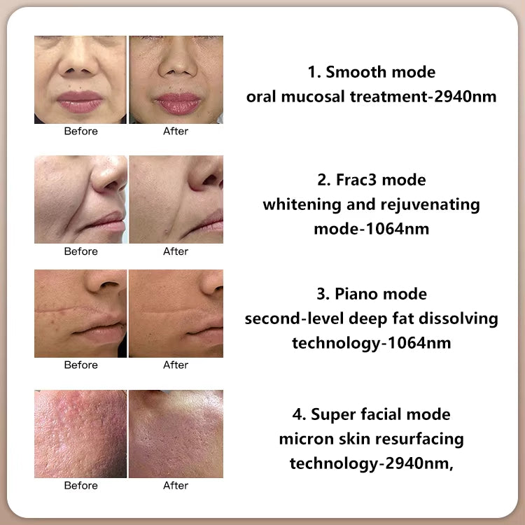 4D Co2 Fractional Laser Machine Fotona 4d Erbium Yag Laser 2940 Fotona Laser Fraccionado Co2 Dermatology Equipment